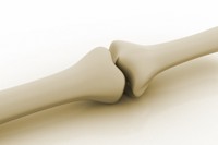 knee joint artrosis